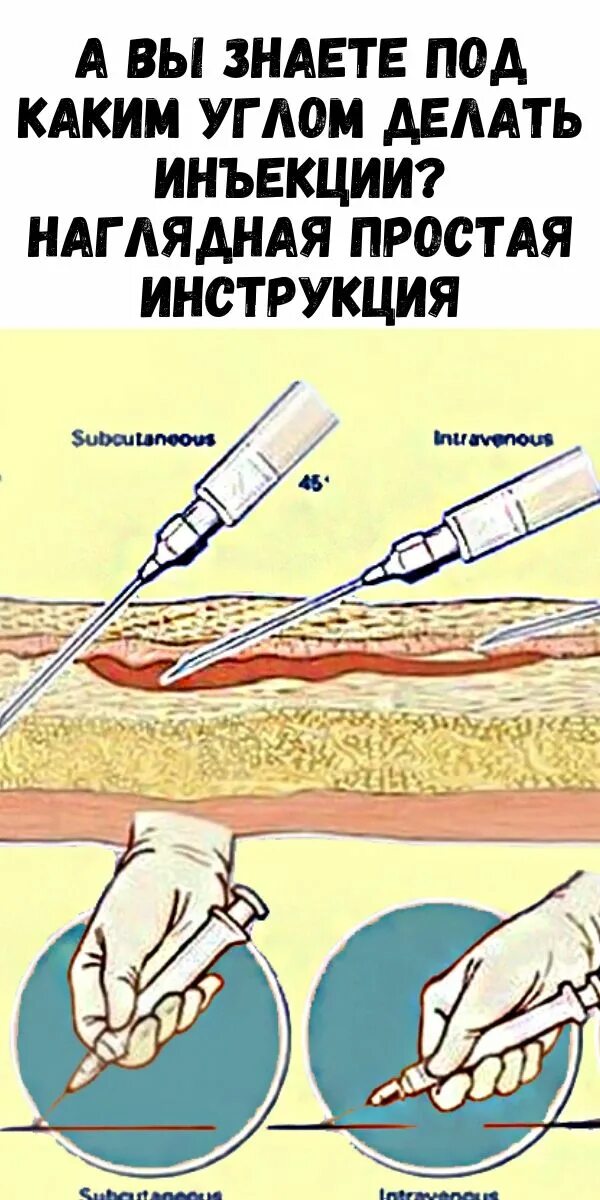 Как держать иглу. Углы введения инъекций. Под каким углом делать укол. Подкожное Введение угол. Внутривенно внутримышечно внутрикожно.