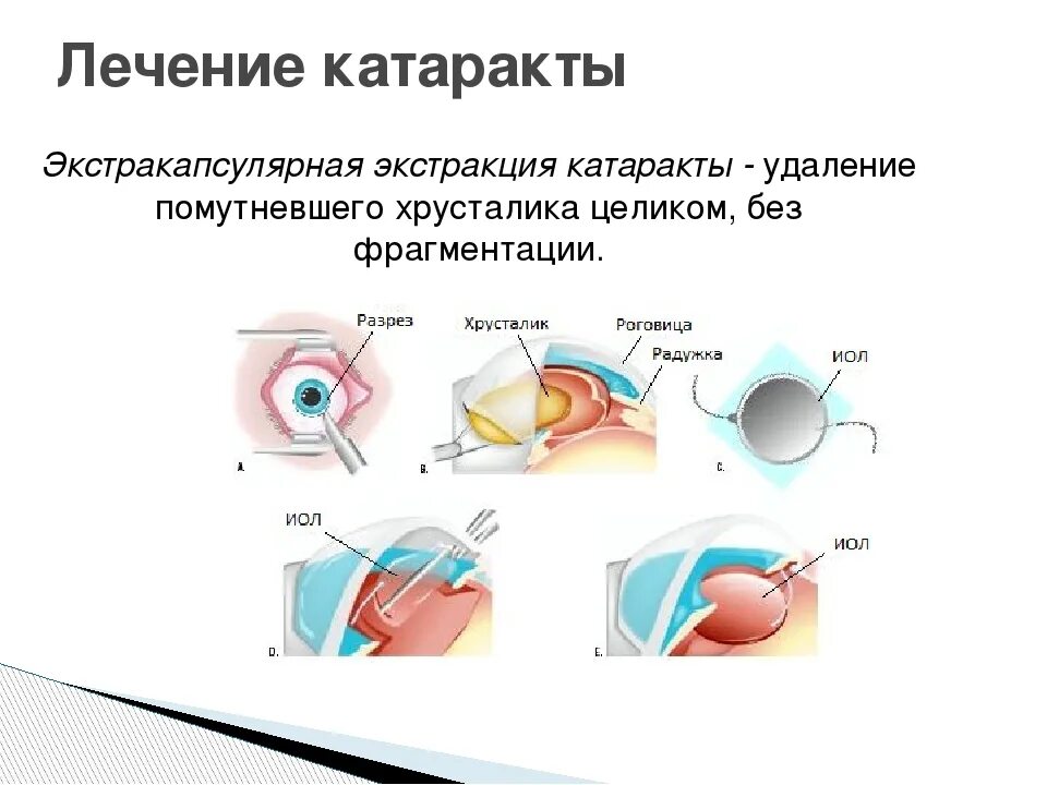 После лечения катаракты