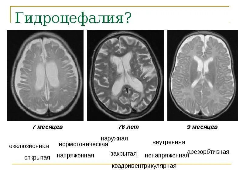 Наружная гидроцефалия головного мозга мрт. Наружная гидроцефалия головного мозга симптомы. Гидроцефалия головного мозга на кт.