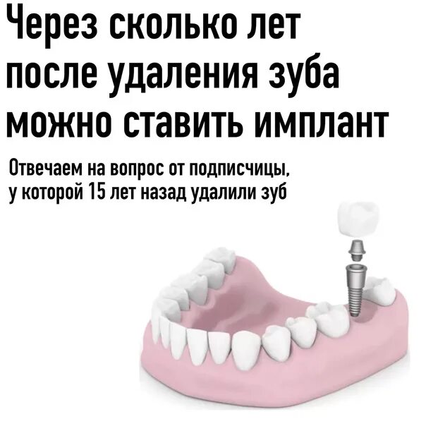 Можно ли поставить зуб после удаления. Через сколько можно есть после удаления зуба. вырвали зуб через сколько. удалили зуб через сколько можно кушать. через сколько можно кушать после удаления зуба.