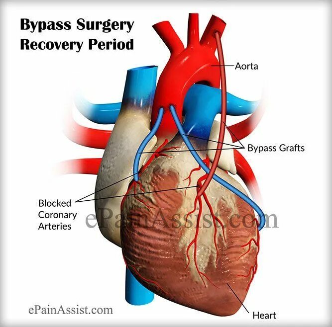 Bypass mode