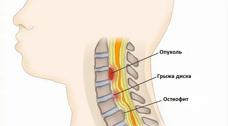 Между 5 и 7 позвонком