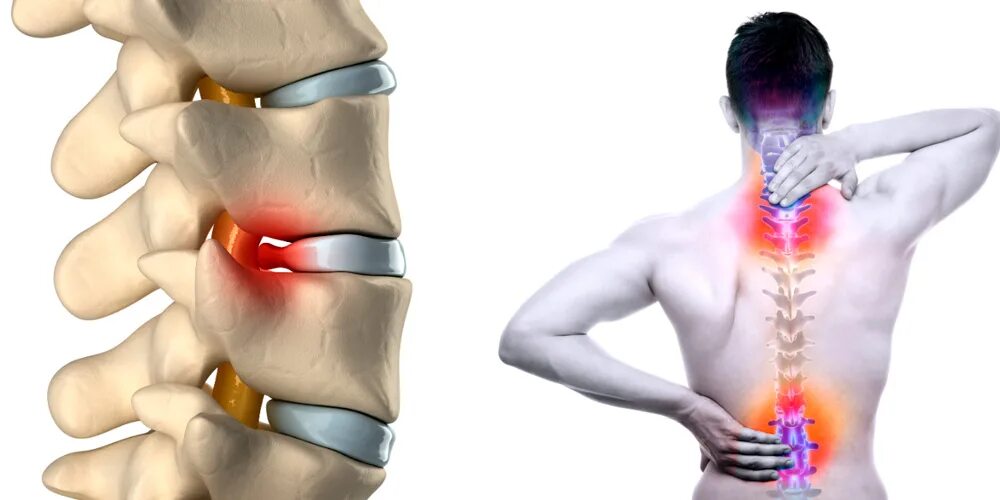 Боли в спине протрузии. Спинно позвоночная грыжа. Межпозвонковая грыжа поясничного отдела симптомы. Грыжа позвоночника поясничного отдела канал. Грыжа позвоночного диска поясничного отдела.