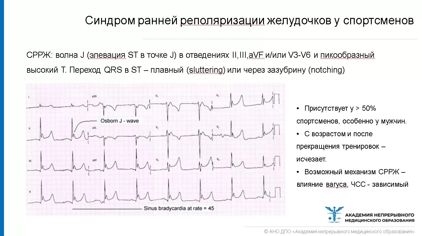 Ранняя реполяризация желудочков сердца на ЭКГ. Синдром ранняя реполяризация желудочков сердца. Ранняя реполяризация желудочков на ЭКГ. Синдром ранней реполяризации желудочков ЭКГ критерии. Нарушение признаков реполяризации