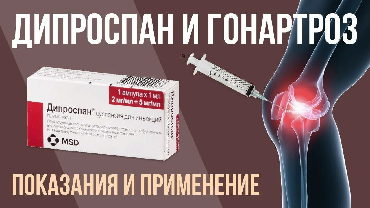 Название уколов для суставов колена. Блокада для суставов Дипроспан. Блокада Дипроспан коленный сустав. Дипроспан в коленный сустав.