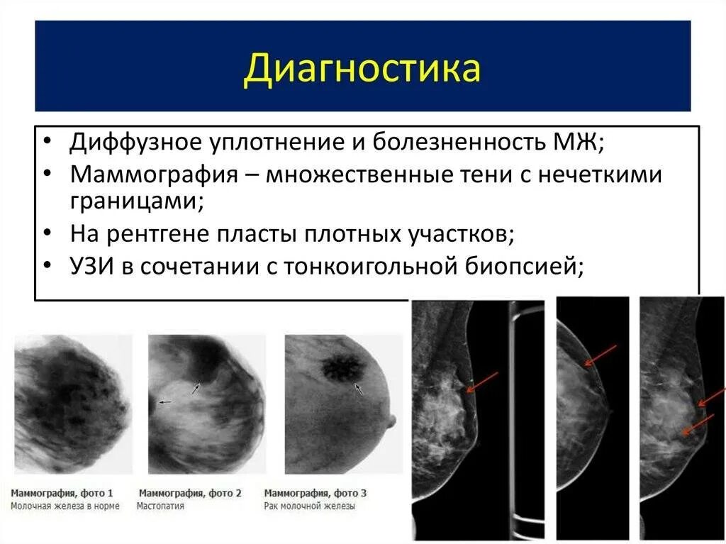 Признаки фиброзных изменений молочных. Фиброзно кистозная мастопатия маммограмма. Кистозная мастопатия маммография. Диффузная фиброзно-кистозная мастопатия маммограмма. Фиброзно-кистозная мастопатия молочных желез на маммографии.