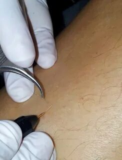 Электроэпиляция ростов на дону