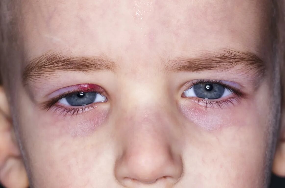 Детская глазная болезнь. Ангулярный конъюнктивит. Поллинозный конъюнктивит. Конъюнктивит ячмень глазная..