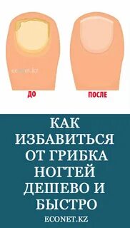 Быстро избавиться от грибка ногтей на ногах