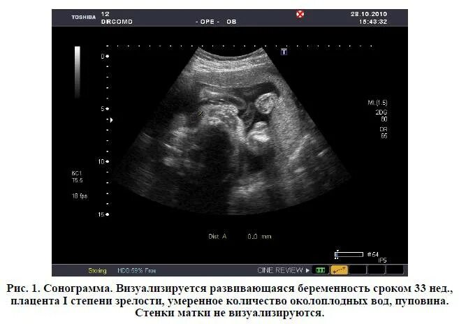 Тонус передней стенки матки. Гипертонус на УЗИ. Брюшная беременность УЗИ. Гипертонус матки на УЗИ при беременности.