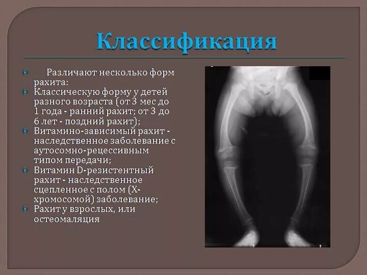 Рентгенологическая картина рахита. Острый рахит