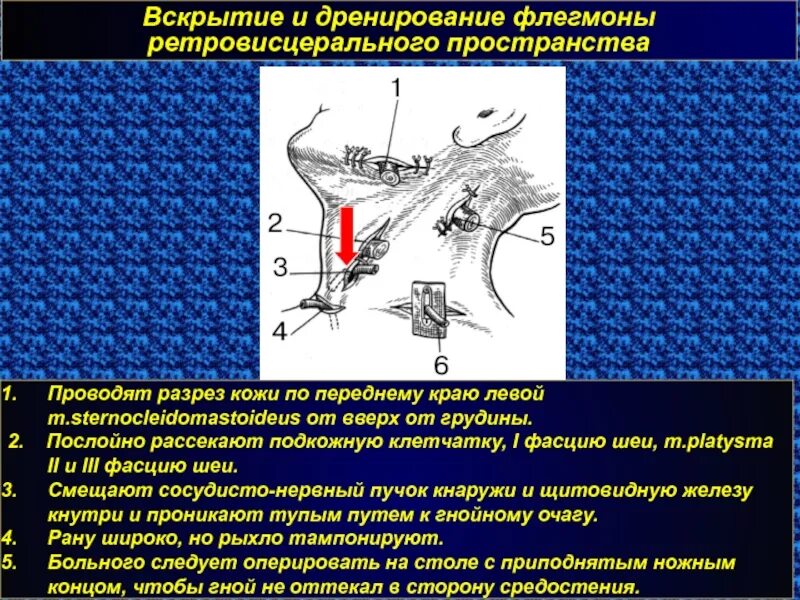 Операция абсцесс шеи. Вскрытие и дренирование флегмоны. Вскрытие и дренирование флегмоны ретровисцерального пространства. Дренирование клетчаточных пространств шеи.