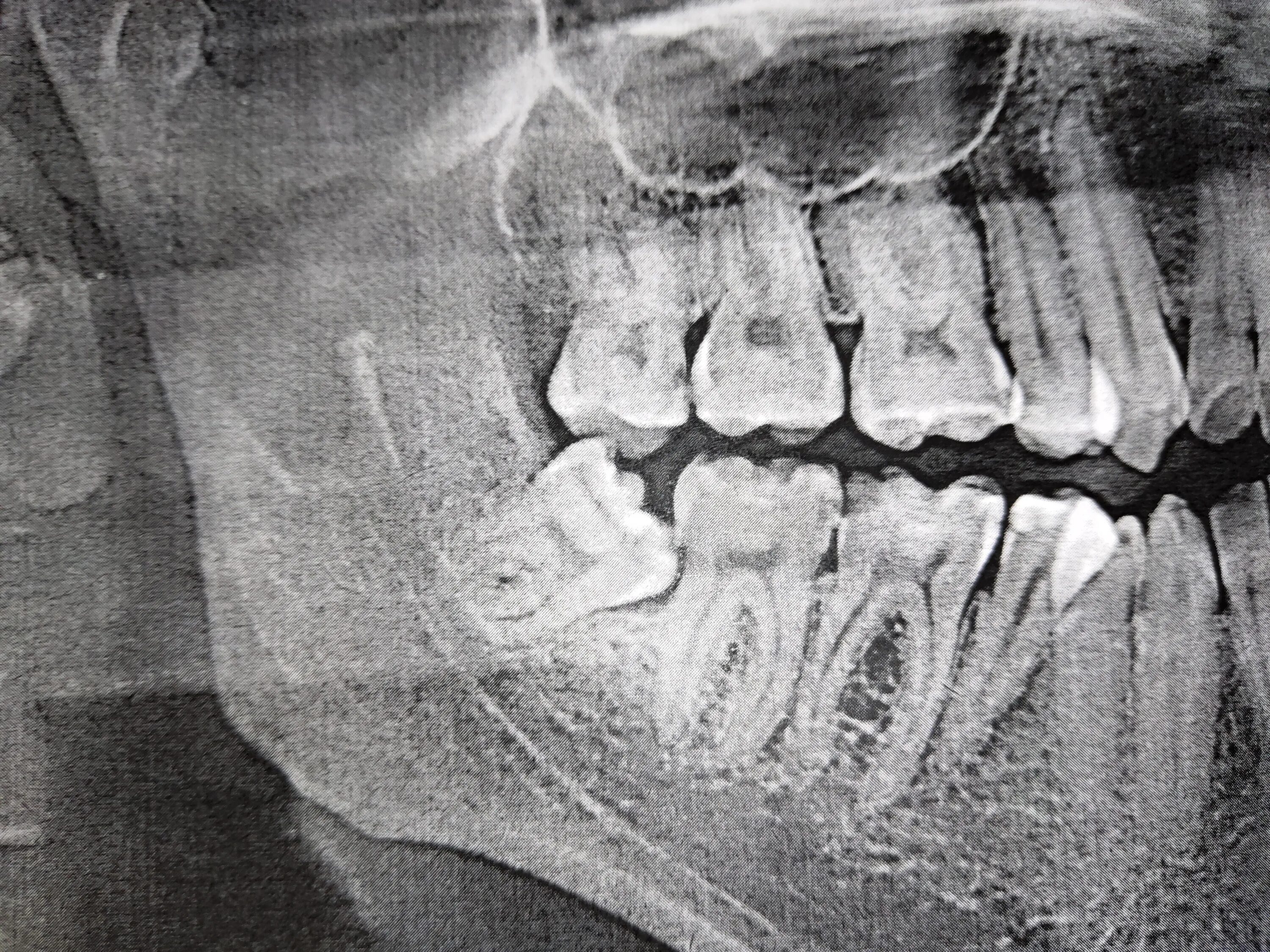 Зуб 8 корень. Снимок зуба мудрости снизу. Ретинированный зуб мудрости рентген. Рентген зубов зуб мудрости.