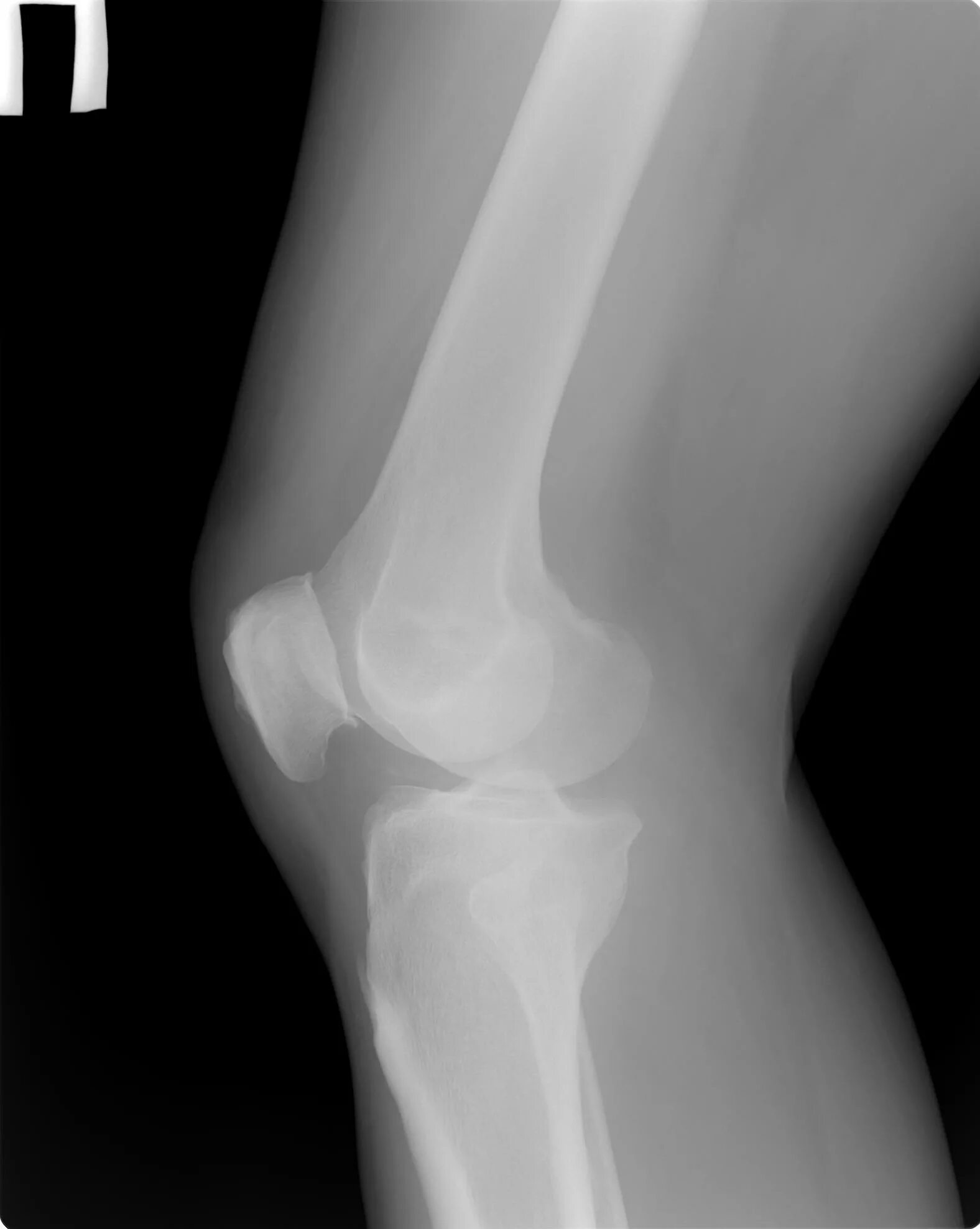 Мыщелка ноги. Перелом мыщелков большеберцовой кости. Перелом мыщелка бедренной кости. Перелом латерального мыщелка бедренной кости. Перелом мыщелков большеберцовой кости рентген.
