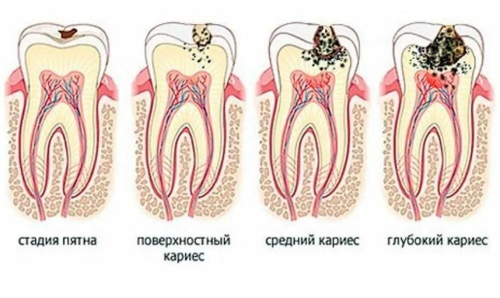 Поверхностный средний и глубокий кариес. Кариас. Кариас. Кариас. Кариас.