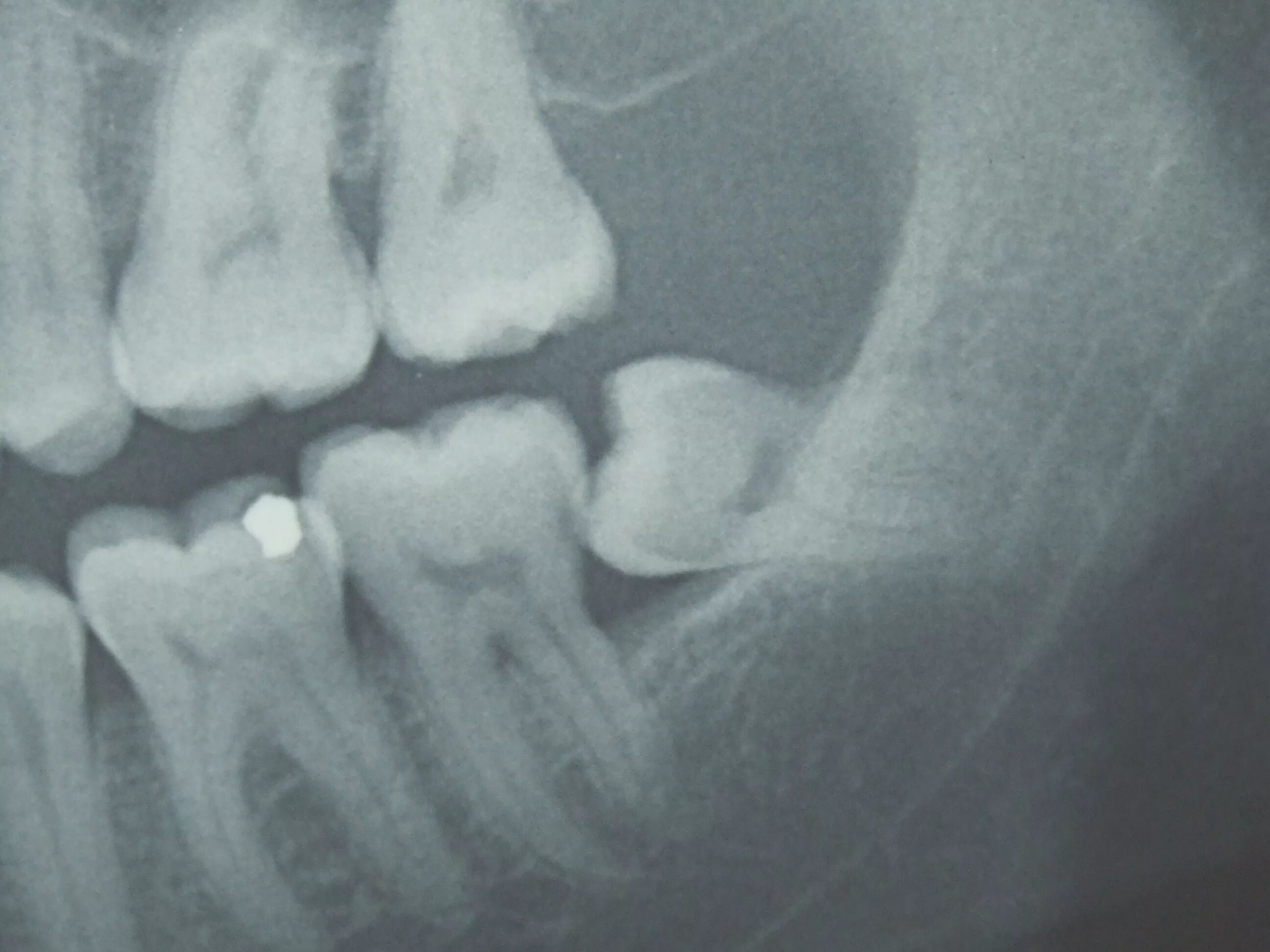 Зуб 8 нижний. Прорезывание зуба мудрости рентген. Зуб мудрости рентген снимок. Снимок челюсти с зубами мудрости.