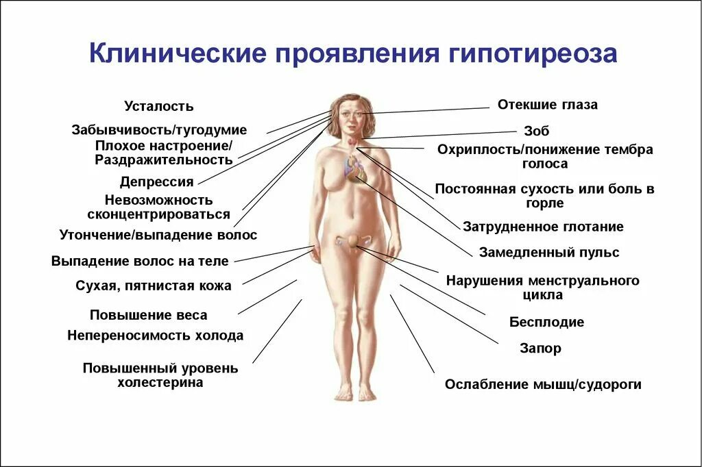 Лечение гипотиреоза без гормонов. Щитовидная железа симптомы заболевания гипотиреоз. Основные клинические проявления гипофункции щитовидной железы. Гипотиреоз щитовидной железы симптомы. Клинические проявления гипотиреоза.