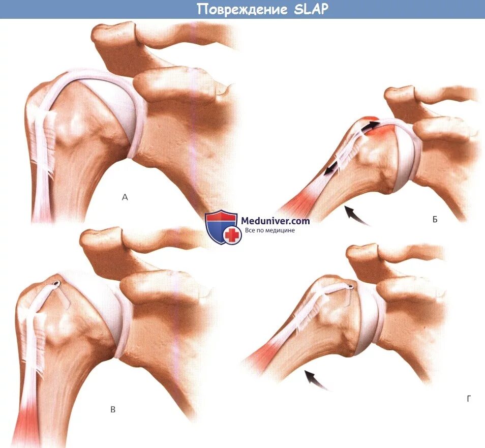 Повреждение губы плечевого сустава. Слэп повреждение плечевого сустава. Слап синдром плечевого. Slap синдром плечевого сустава операция.
