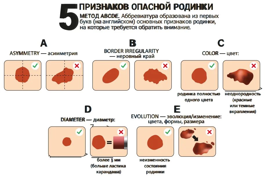 Злокачественные родинк. О чем говорит количество родинок. О чем говорит количество родинок. Формы злокачественной родинки. О чем говорит количество родинок.