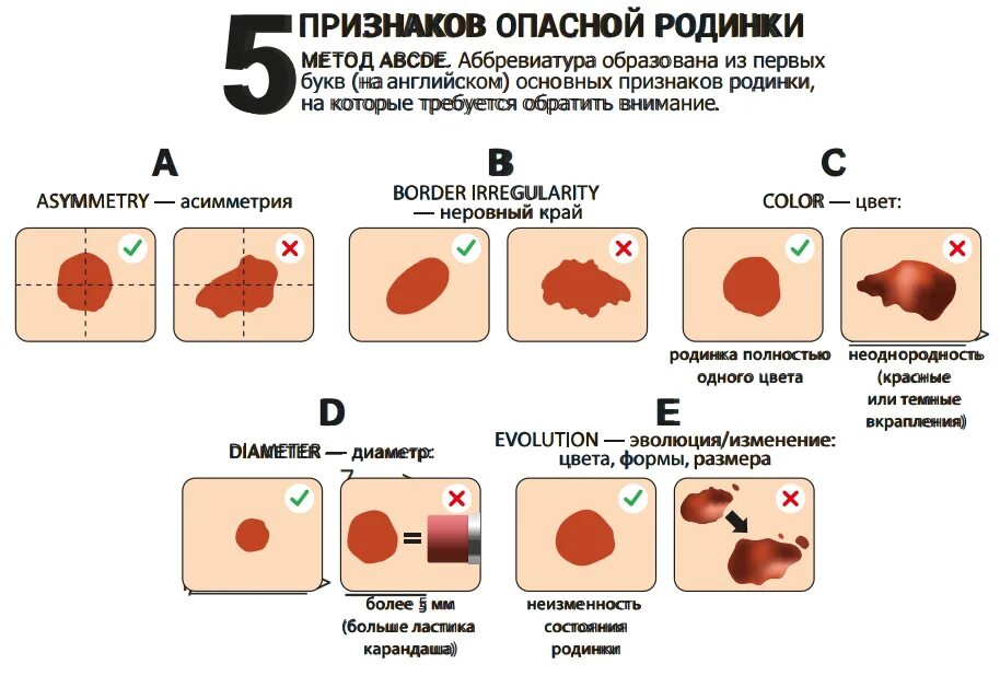 Классификация АВСД меланома. Изменение формы родинки. Родинка сюжет кратко