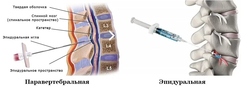 Эпидуральная блокада при грыже. Эпидуральная блокада поясничного отдела позвоночника при грыже. Паравертебральная блокада позвоночника. Трансфораминальная эпидуральная блокада поясничного отдела.