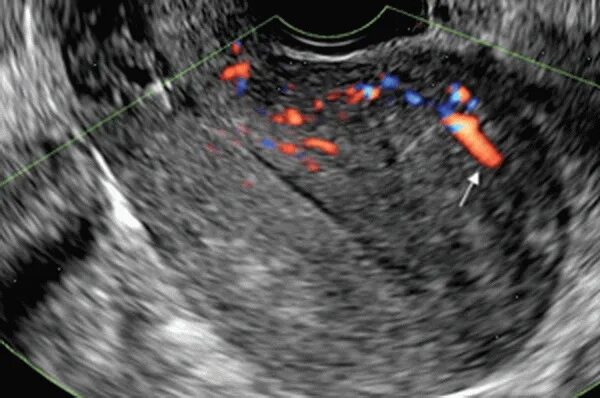 Узловая форма аденомиоза по УЗИ. Эхопризнаки аденомиоза что это