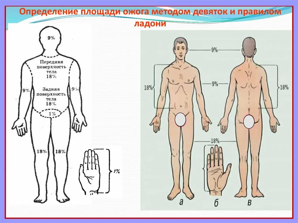 Правило девятки определение. Правило девятки определение. Метод определения ожоговой поверхности. Термические ожоги площадь поражения по степеням. Измерение площади ожога ладонью.