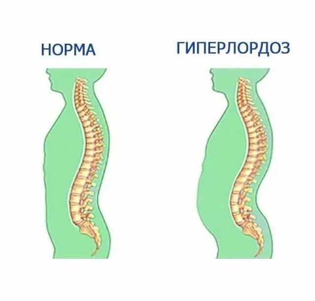 Поясница назад. Лордоз поясничного отдела. Гиперлордоз пояснично-крестцового отдела. Лордоз и гиперлордоз. Поясничный лордоз усилен рентген.