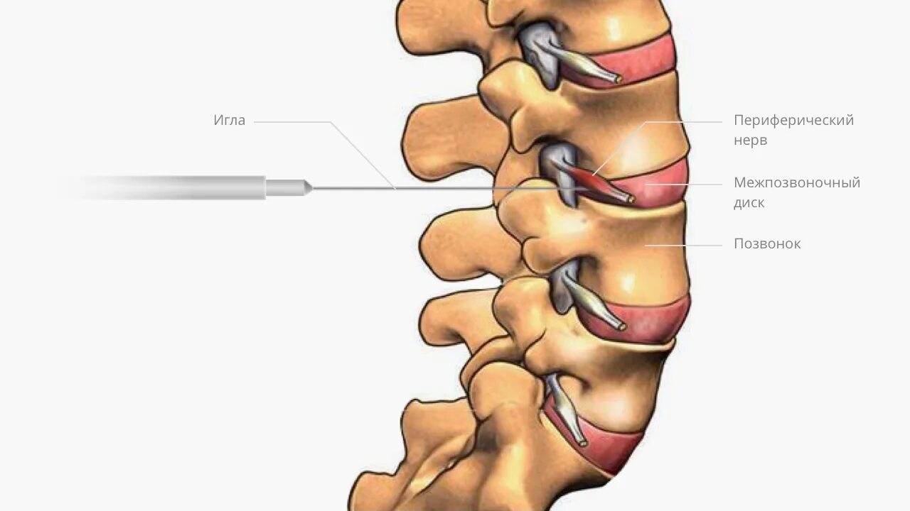 Блокада спины цена. Спондилоартроз l2-s1 что это такое. Фасеточные суставы поясничного отдела позвоночника. Блокада фасеточных суставов поясничного отдела позвоночника. Спондилоартроз фасеточных суставов.