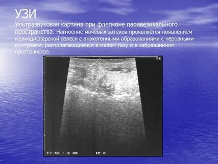 Мелкодисперсная взвесь в желчном пузыре что это