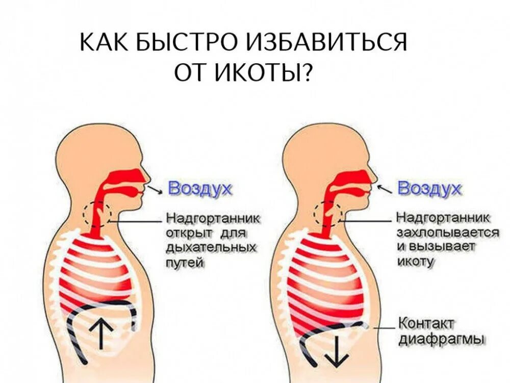 Быстрее спасайся. Икота. Почему человек икает. Почему человек икает причины. Методы избавления от икоты.