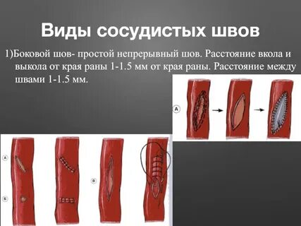 Основные виды сосудистого шва