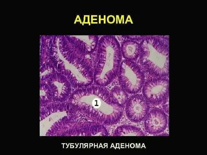 Тубулярная аденома что это такое