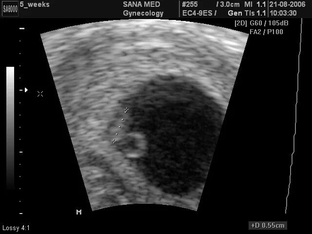 Беременность 2 нед. Снимки УЗИ на 1 недели беременности. Снимок УЗИ на второй неделе беременности. Снимок УЗИ беременности 1-2 недели. 1 Месяц беременности фото плода на УЗИ.