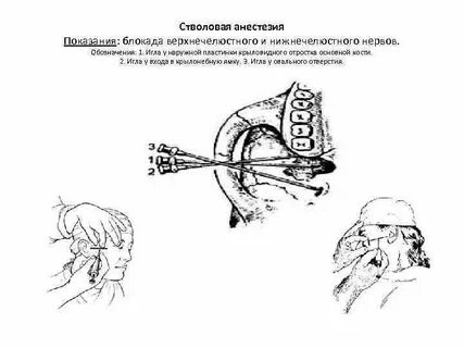 Блокада анестезия