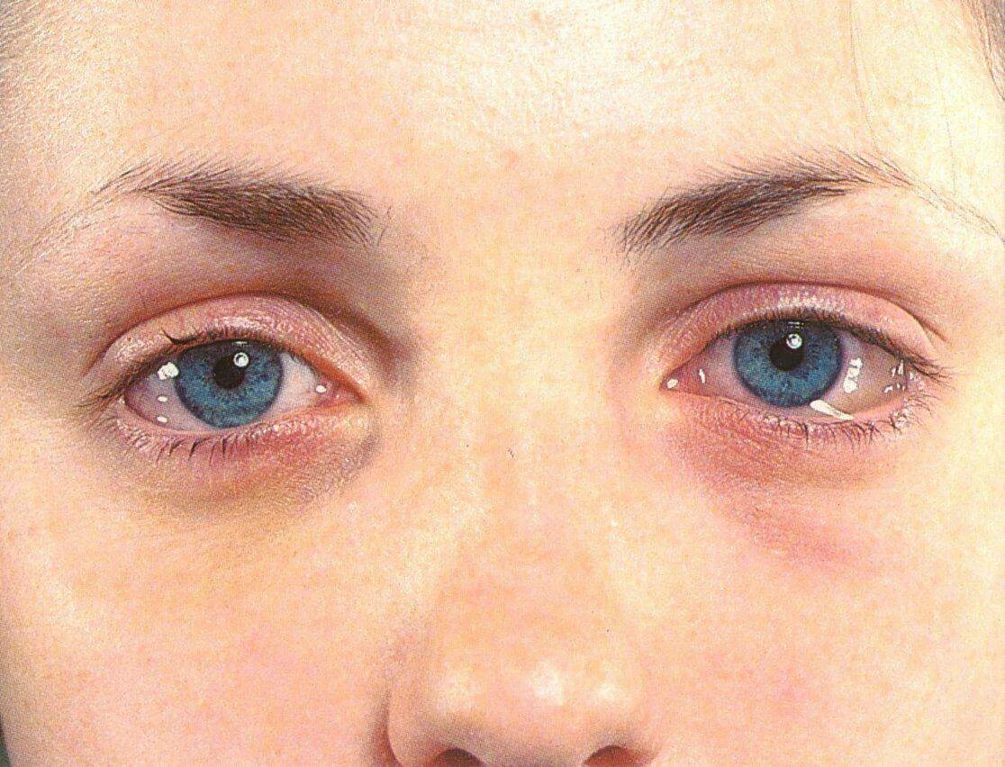 Лимбальный кератоконъюнктивит. Почему вылазит глаз