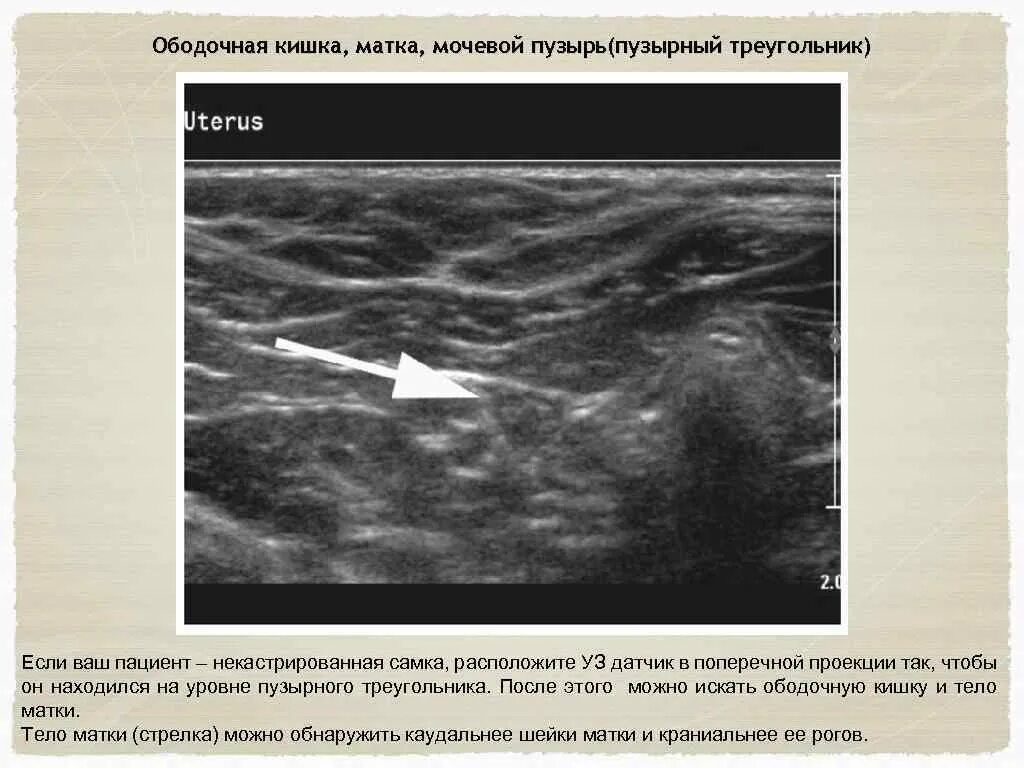 Расположение матки и мочевого пузыря. Расположение мочевого пузыря в брюшной полости. Треугольник Льето мочевого пузыря на УЗИ. Кишечник матка и мочевой пузырь.