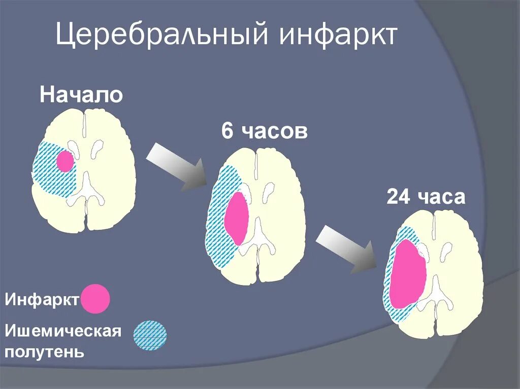 Зона инсульта. Церебральная форма инфаркта миокарда. Церебральный вариант инфаркта миокарда. Пенумбра зона ишемической полутени.