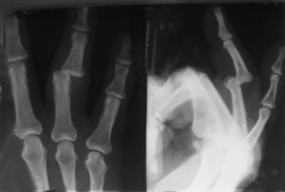 ушиб шейного отдела позвоночника код мкб у детей 10. ранение плечевого сустава. подвывих дистальной фаланги. мкб-10 международная классификация болезней 2020. вывих пальца мкб 10.