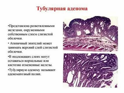 Аденокарцинома кишки low grade g2