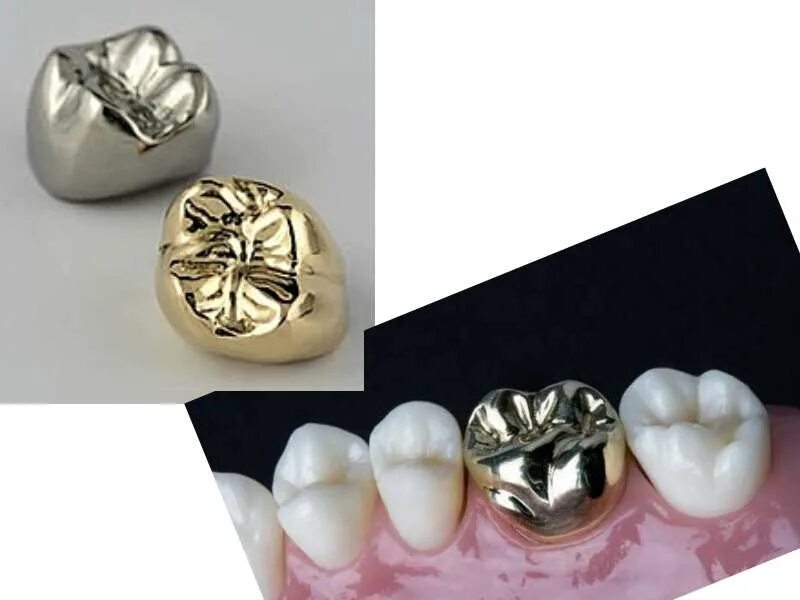 коронка металлокерамическая (фасетка). коронка цельнолитая (сплав remanium). цельнолитая коронка (кхс с напылением). коронка цельнолитая из металла cocr. стальная коронка на зуб.