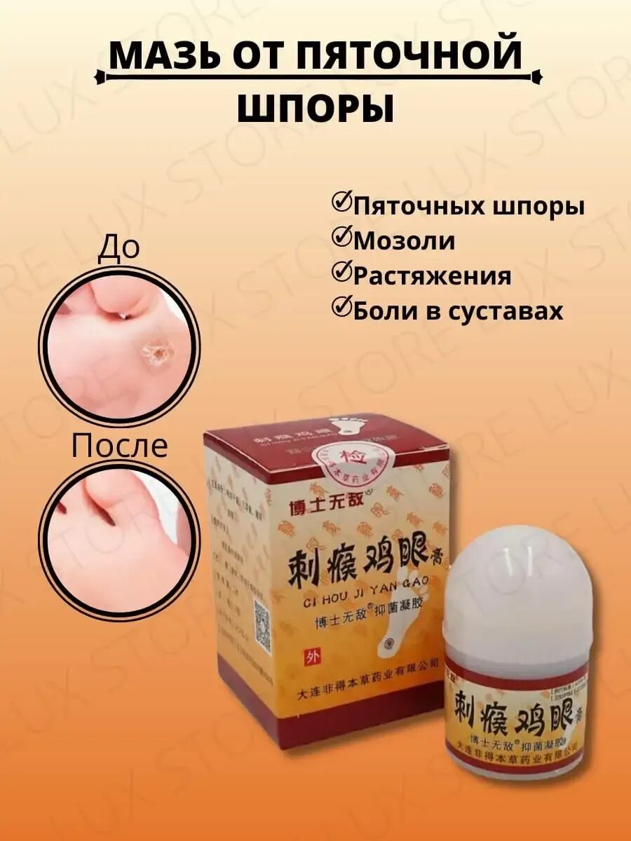 На пятке шпора чем лечить какой мазью