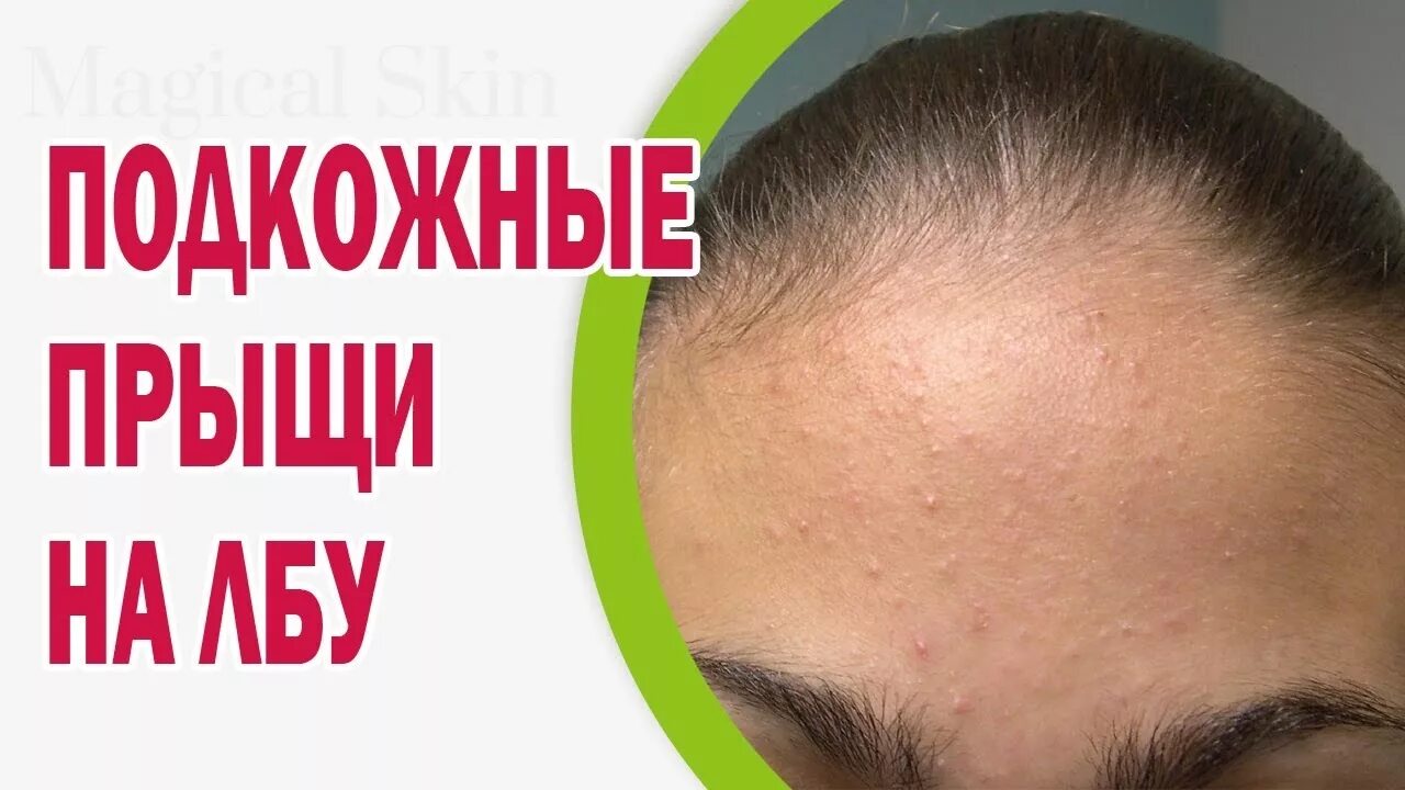 Как быстро избавиться от прыщей на лбу. Подкожный прыщ шишка на лбу. подкожные прыщи на лбу причины.