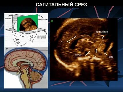 Сагитальный