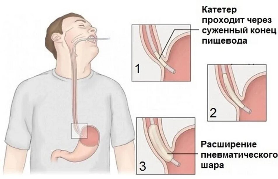 Лечения пищевода домашних условиях. Баллонная дилатация пищевода. Балонный катетер для пищевода. Баллонная кардиодилатация пищевода. Эндоскопическая баллонная дилатация пищевода.