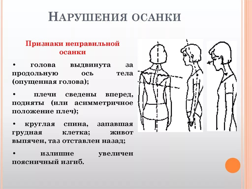 Нарушение осанки доклад. Нарушения осанки у детей. выявление нарушения осанки. признаки неправильной осанки. заболевания связанные с нарушением осанки.