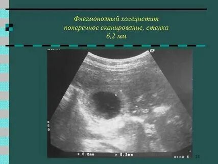 Что такое липоматоз поджелудочной железы 1 степени