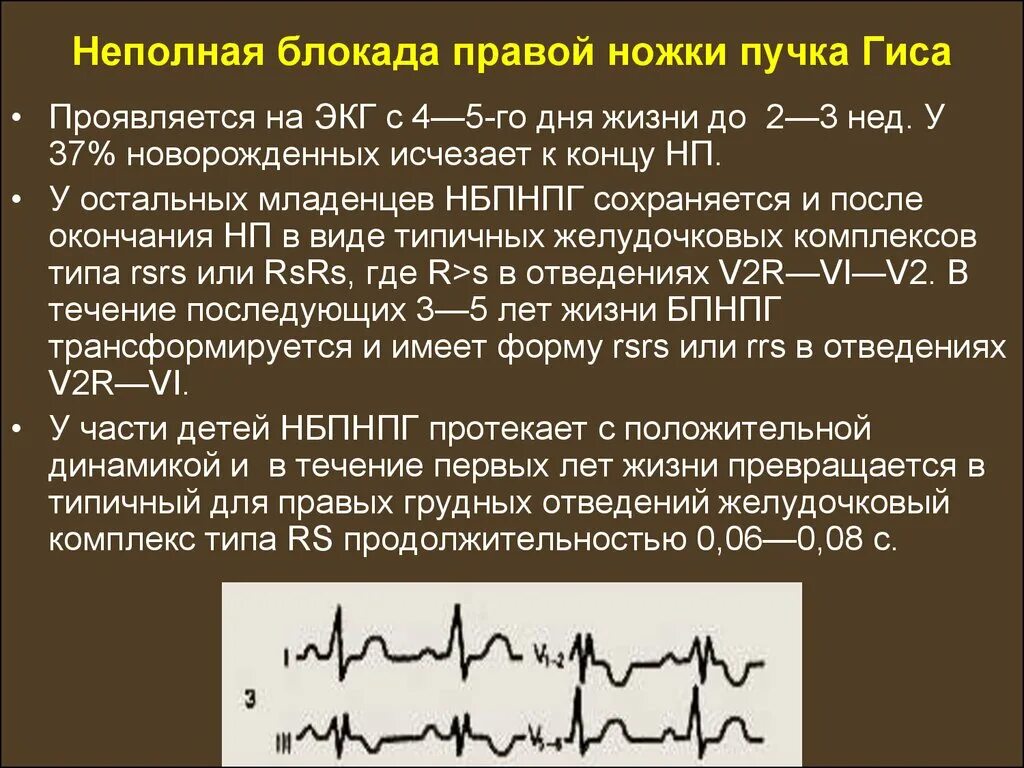 Частичная блокада ножки пучка гиса