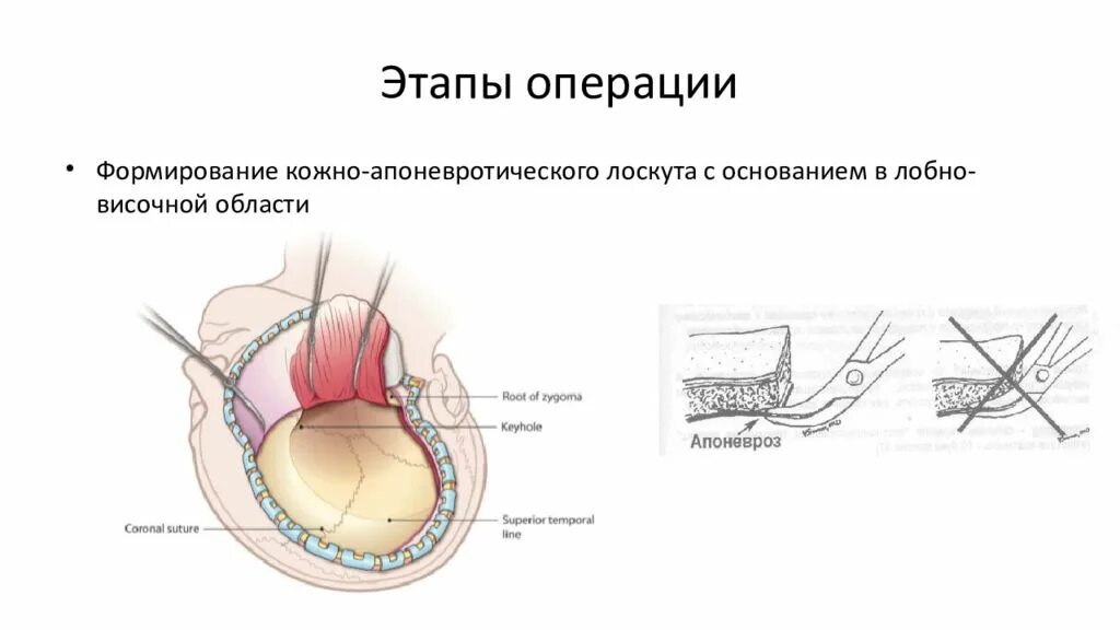 Этапы после операции. Кожно апоневротический лоскут. Декомпрессивная краниэктомия. Формирование кожно-апоневротического лоскута.