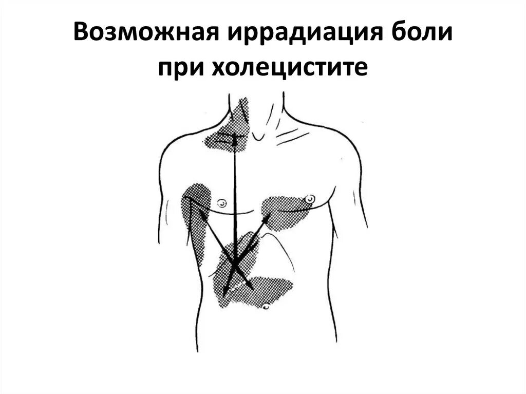 Боль без иррадиации. Холецистит иррадиация болей. Иррадиация боли при хроническом холецистите. Хронический холецистит локализация боли. Локализация боли при остром холецистите.